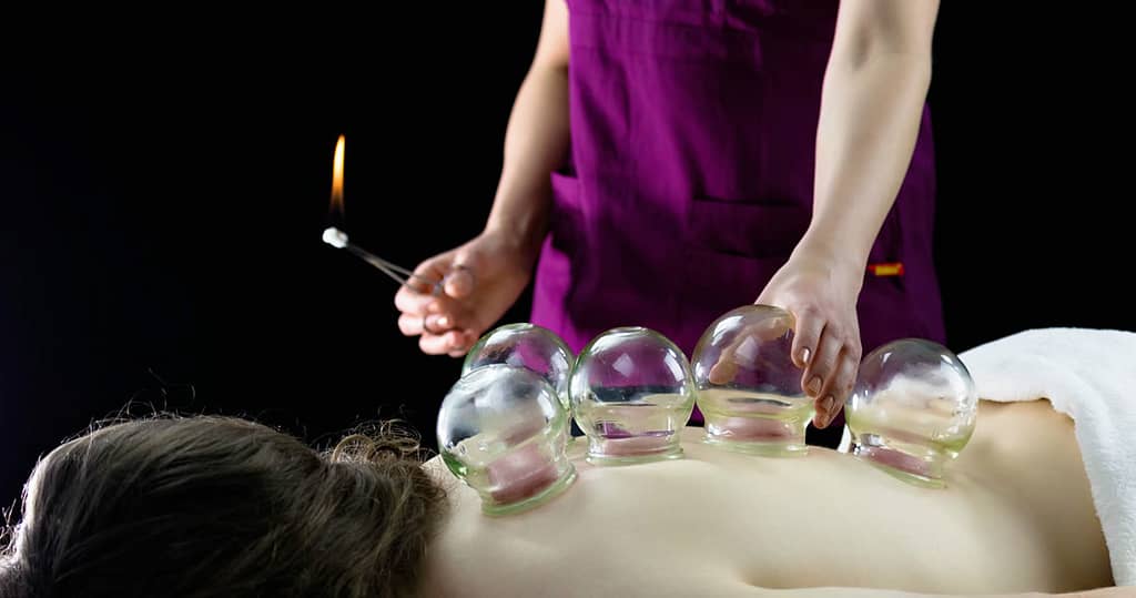Cupping_Therapy
