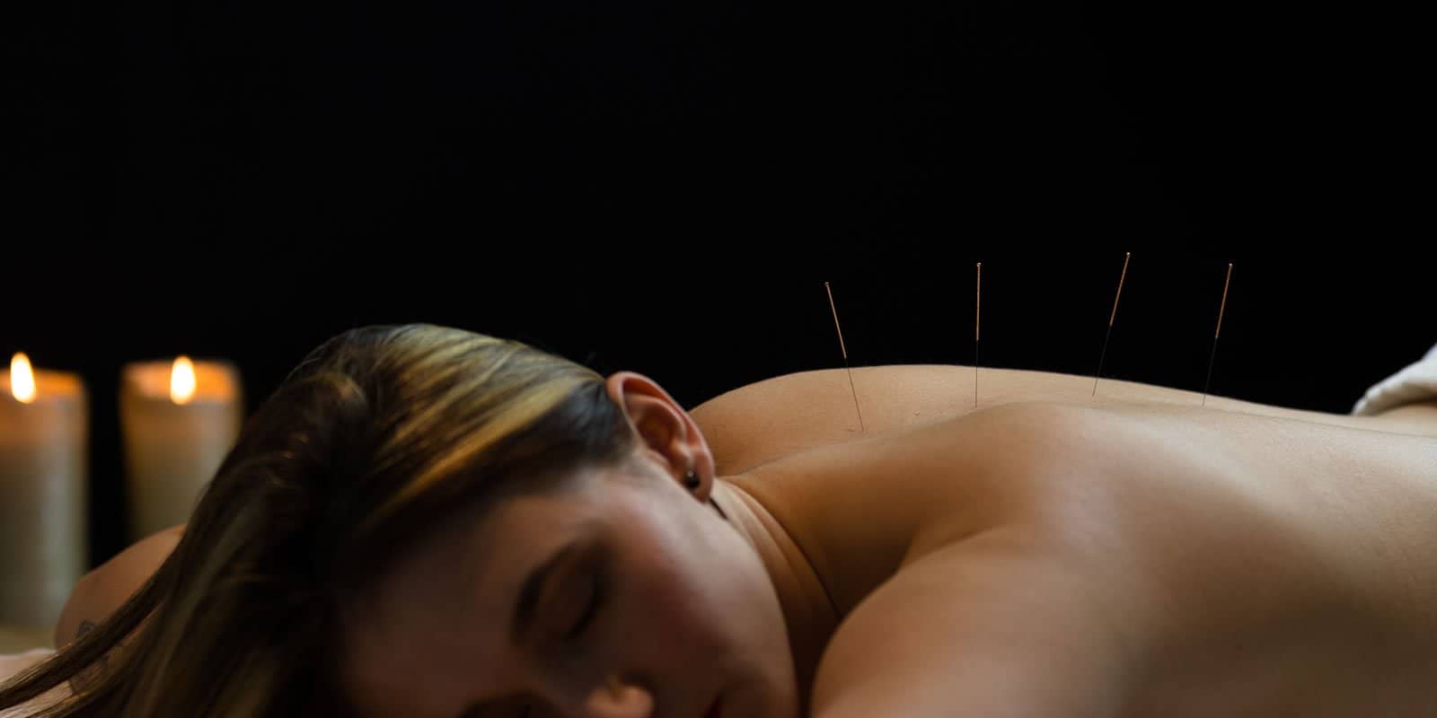 acupuncture_13